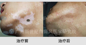 晕痣型白癜风能治好吗